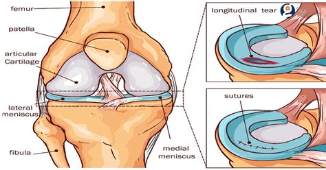 Athroscopic surgery is often used. Meniscus Tear Repair: Meniscus Tear, Causes, Symptoms ...
