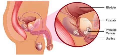 Cancer which has spread to the lymph nodes can sometimes be detected if the lymph nodes have become enlarged. PROSTATE CANCER - The Silent Killer...of Men! - Redcare