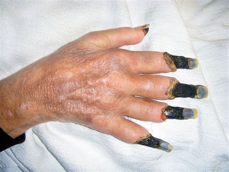 Our aim is to report our experience in treatment of fg and. what causes gangrene - pictures, photos