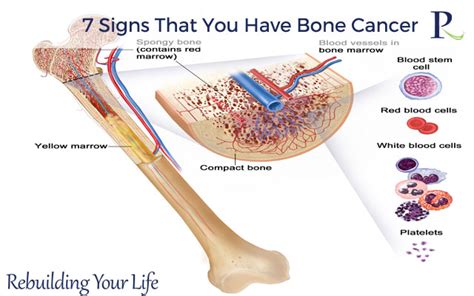 Signs and symptoms of bone cancer include: Read about 7 Signs That You Have Bone Cancer