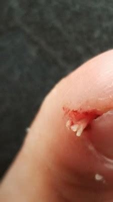 I accidentally dicovered a way to get the real live parasites (protazoas?) to leave my skin!! morgellons - All About Worms