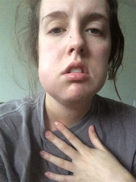 This will minimize inflammation and swelling. Facial Swelling After Wisdom Teeth Removal - Porn Pics