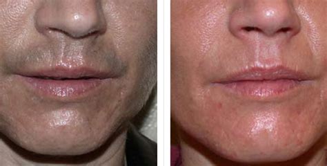 Some want to leave a goatee or some small amount of hair on their upper lip, while others want to completely wipe their face clean. Beard Hair Removal |The LightBarr