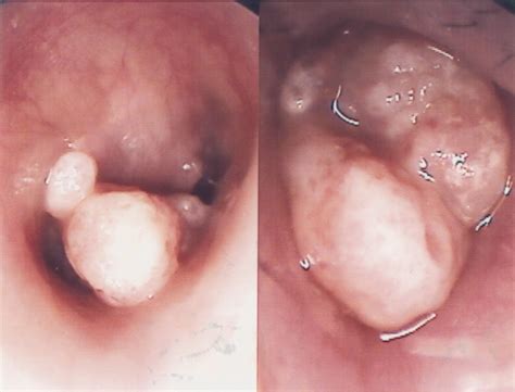 Its unsuspecting inhabitants, once a strong. Eosinophilic Granuloma of the Middle Ear | The Journal of ...