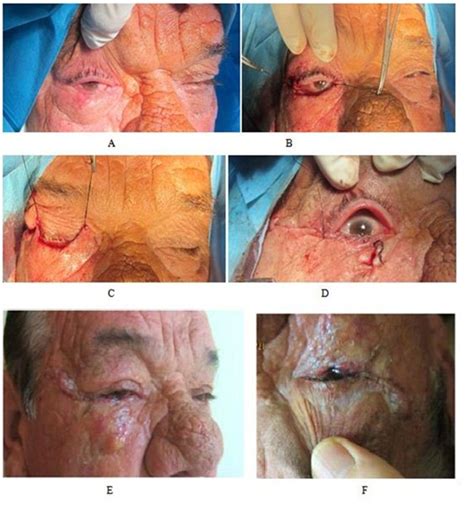 In spite of the fact that eyelid surgeries are not varied quite much, the surgical design and physician's esthetic outlook. Choosing the Appropriate Reconstructive Technique for Eyelid Defects after Tumor Excision