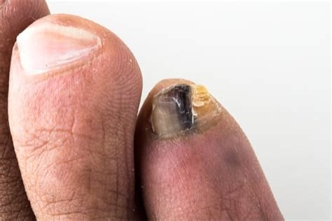 Damage to the end of nails change colors for multiple reasons. What Color is Toenail Fungus? — Yellow Toenails Cured