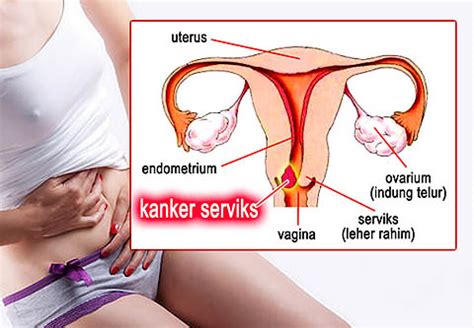 Keputihan atau mengeluarkan sedikit darah setelah melakukan hubungan intim adalah sedikit tanda gejala dari kanker ini. MENGETAHUI BAHAYA KANKER SERVIKS SEJAK DARI AWAL ...