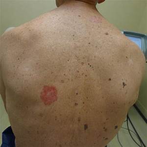 Skin Cancer, Symptoms, Pictures, Photos, Types, Signs, Melanoma Skin Cancer  