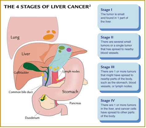 Hepatoblastoma is the most common liver cancer of childhood, although it affects only 2 to 3 people in a million. Cancerul hepatic - Tratament NaturistTratament Naturist