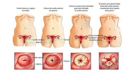 O que é o câncer de colo uterino é um tumor que acomete a porção inferior do útero, chamada colo ou cérvix. (ULACCAM) Unión Latinoamericana Contra el Cáncer de la ...