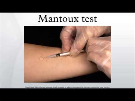 Ppd is the abbreviation for the purified protein derivative of tuberculosis bacteria. Mantoux test - YouTube