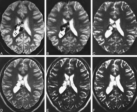 Vitreous hemorrhage has an incidence of seven cases per 100,000, which makes it one of the most common causes of acutely or subacutely decreased vision. Detection of Intracranial Hemorrhage with Susceptibility ...