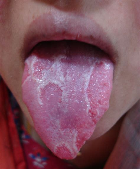 The most noticeable signs of tongue cancer are a sore on the tongue that does not heal and a painful tongue. www.BestOgdenDentist.com Blog: Geographic tongue