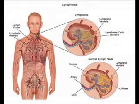 Survival rates from blood cancer have improved in recent years, thanks to newer treatments. Blood cancer symptoms - YouTube