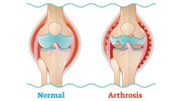 Im laufe der erkrankung kommt es. Die richtigen Schuhe bei Arthrose | tessamino.de