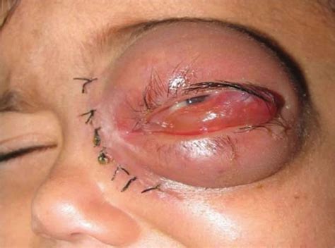 Mucormycosis is any fungal infection caused by fungi in the order mucorales.:328 generally, species in the mucor, rhizopus, absidia, and cunninghamella genera are most often implicated. Mucormycosis causes, symptoms, diagnosis, treatment ...