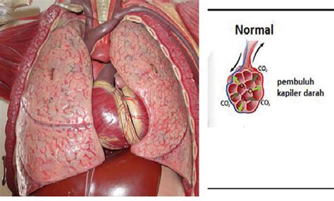Jenis jangkitan paling utama di saluran pernafasan adalah penyakit pneumonia. Proses Ekskresi Yang Terjadi dalam Paru-Paru | awalilmu ...