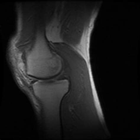 Es ist eine bildgebende untersuchung mittels derer. MRT: Knie - DocCheck