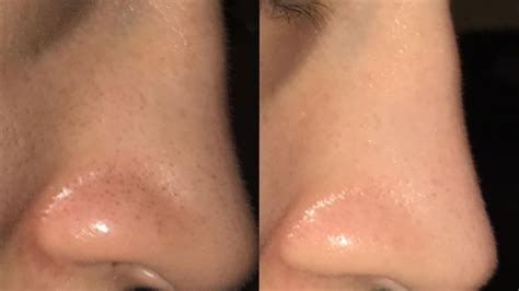 We've put together a simple regimen for large pores using only products by the ordinary that can help to minimise the size of your pores. Woman Says Skin-Care Routine Got Rid of Blackheads in One ...