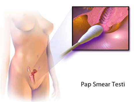 During a pap test, the doctor collects cells from your cervix (located at the bottom of your uterus). Pap Smear - Hemen Sağlık