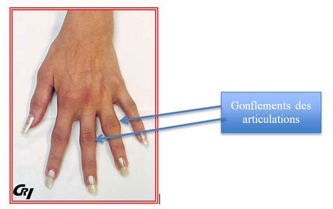 Douleur Articulation Doigt Index : Canal Carpien Depister Le Syndrome ...