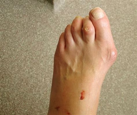 She says she experiences some intermittent pain under the nail. Hammer Toes - Pictures, Surgery, Causes, Treatment
