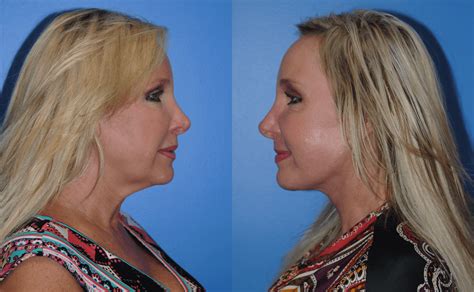 Neck Recontouring with Newport Beach Surgeon, Dr. Brian ...