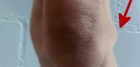 Die starken schmerzen können das gesamte kniegelenk, die kniescheibe (patella) oder natürliche hausmittel behandeln die schmerzen und können die beweglichkeit des kniegelenks verbessern. Meniskusganglion - Schwellung am Meniskus | Knie Marathon