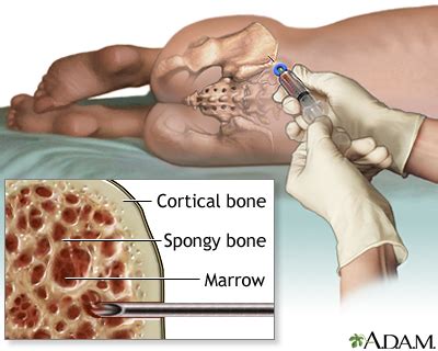 In dogs, bone cancer also can occur as a primary or metastatic disease, but in contrast to humans, the most common form of bone cancer seen in dogs in the definitive diagnosis requires a biopsy, which can be obtained through an open incisional biopsy, a trephine biopsy, or a jamshidi bone marrow. Bone marrow biopsy