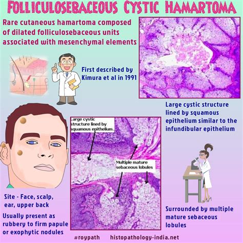 A large hamartoma of the spleen. Pathology of Folliculosebaceous Cystic Hamartoma #roypath ...