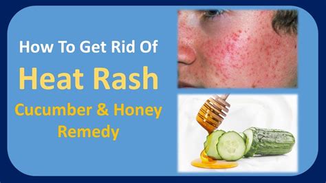 Heat rash (miliaria, prickly heat is caused by overexposure to a hot environment. how to get rid of heat rash - Cucumber & Honey Remedy ...