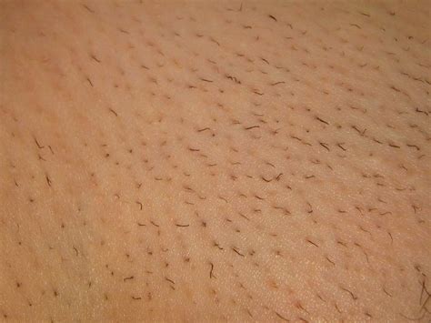 The cost of bikini laser hair removal or brazilian laser hair removal is all dependent upon how much hair is removed from the area. Bikini Area Photos - Teen Porn Tubes