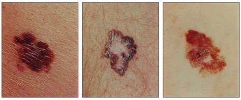 Tratamiento del melanoma (PDQ®)-Versión para profesionales ...