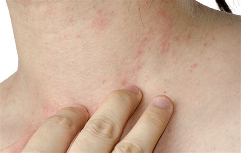 ¿Qué es un eccema? | blog COFM