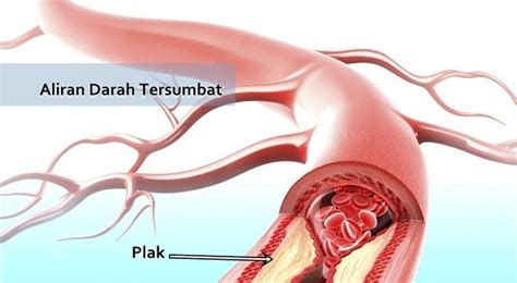 Siapkan air mandi rendam yang cukup hangat (dengan atau tanpa garam epsom, yaitu garam mineral yang baik untuk kesehatan) dan bersantailah selama 20 sampai 30 menit. Pengobatan Alami Untuk Melancarkan Aliran Darah Yang ...