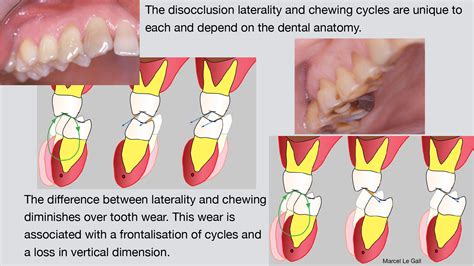 The group function occlusion on working side distributes the occlusal load and prevents teeth on non working side from being subjected to the destructive, obliquely directed forces. Fig C 25 1 E - THE OCCLUSAL FUNCTION