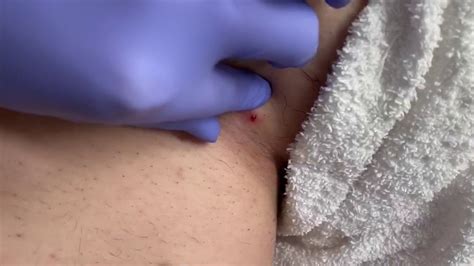 Basically, anyone who removes pubic hair is at a higher risk for ingrown hairs, and pubic hair removal is common. Bikini Line Ingrown Hair Removal - YouTube