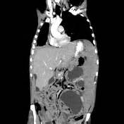 Mar 01, 2001 · benign urachal neoplasms including adenomas, fibromas, fibroadenomas, fibromyomas, and hamartomas are extremely rare; Peritoneal mesothelioma | Radiology Reference Article ...