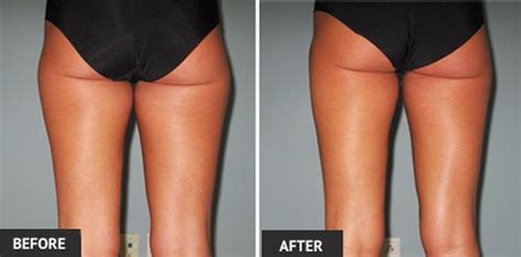 Thigh liposuction basically involves the removal of excess fat from both the inner thigh and the outer thigh. Inner, Outer, and Anterior Thigh Liposuction Procedures