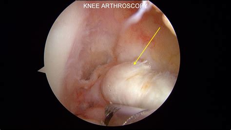 The fia motorsport games after two weeks of intense competition among 230 participants, the top 20 from the acl. Anterior Cruciate Ligament (ACL) Tear I Knee Surgery