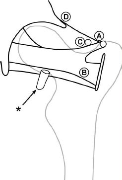 The psoas major unites with the iliacus at the level of the inguinal ligament and crosses the hip joint to insert on the lesser trochanter of the femur. b . Line drawing of the left hip posterior ligaments. A) Insertion of... | Download Scientific ...