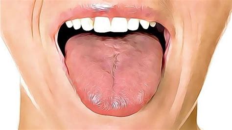 Ce type de cancer se développe dans la partie du système. Les marques sur la langue : ce qu'elles signifient ...
