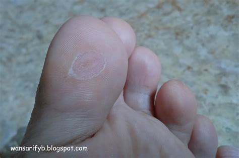 Tapi memang menghapus tato itu sulit banget.karena sifatnya yang permanen, dibutuhkan metode khusus dan waktu yang tidak sebentar untuk bisa hilang sempurna tanpa bekas. Apakah Mata Ikan Bisa Hilang Dengan Sendirinya - Berbagai Mata