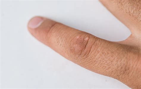Lately skin cancer has been on the rise. 5 نوع خال مشکوک به سرطان پوست - عکس انواع خال سرطانی