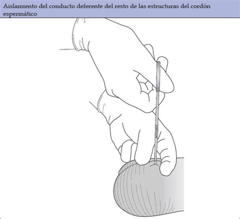 Identificación del conducto deferente izquierdo en el escroto, repitiendo el procedimiento en lado izquierdo. Procedimiento | Vasectomía