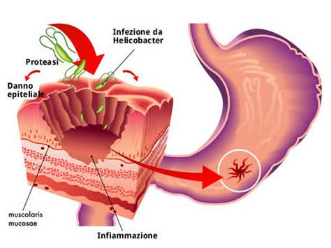 Consigli per scegliere la giusta dieta per la gastrite.essendo un disturbo la cui genesi è fortemente influenzata dallo stile di vita, la gastrite può essere calmata o del tutto risolta applicando alcune variazioni nelle abitudini alimentari. Ulcera peptica - Complicanze - Chirurgo Dott. Stefano ...