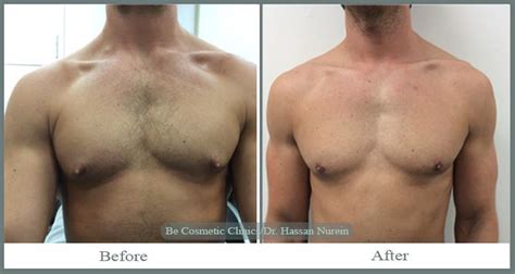 Join our closed group of previous and future patients Gynecomastic (Male Breast Reduction) | Be Cosmetic