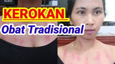 Sering merasa masuk angin, tubuh tidak berada dalam kondisi prima ? NGARIT KUBURAN BADAN SAKIT ...KEROKAN &PIJAT ANGIN DUDUK ...