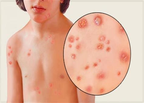 Chickenpox (sometimes spelled chicken pox) is highly contagious and can be spread by contact with the affected areas, or by an infected person children usually recover from chickenpox without any major issues. चिकन पॉक्स के लक्षण जानकर करें इन घरेलू तरीकों से इलाज ...