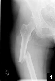 Atraumatic Bilateral Femur Fracture in Long-Term ...
